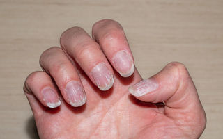 Unghii care se exfoliază. Cauze ascunse, soluții eficiente și când e cazul să mergi la medic