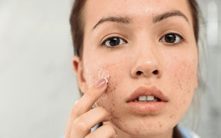 Roaccutane pentru acnee: soluția eficientă care poate schimba vieți, dar are și efecte secundare