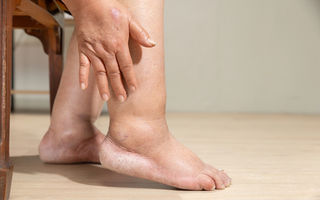 Retenția de apă: cauze, simptome și soluții pentru a scăpa de senzația de umflare