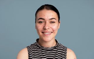 Ten acneic: cauze, greșeli frecvente și soluții care chiar funcționează