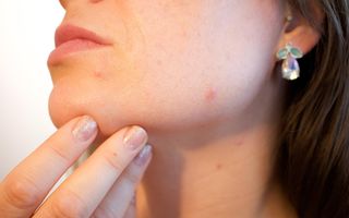 Cum să scapi de acnee la 25+ fără tratamente dure