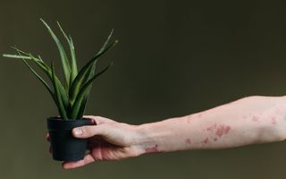 Leacuri naturale pentru arsuri. Ce poți face acasă și când trebuie să mergi la medic