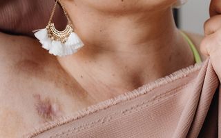 Carcinom scuamos: ce este, simptome, cauze și tratament