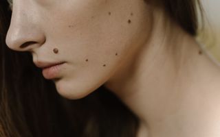 Alunițe apărute brusc: de ce apar, când sunt normale și ce semne trebuie să te trimită la dermatolog