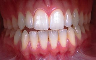 Sângerarea gingiilor: de ce apare, când este normală și când poate ascunde o problemă mai serioasă