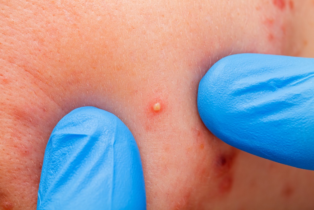 De Ce Iți Apar Coșuri Pe Spate și Cum Scapi Rapid De Ele