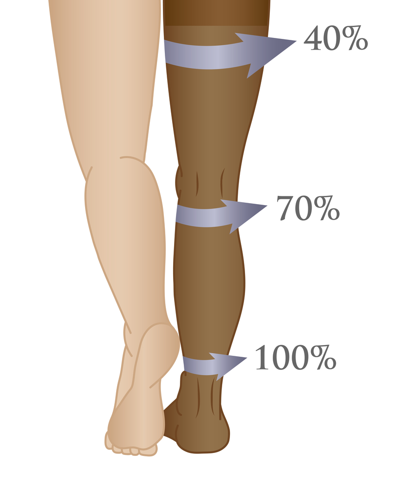 Cum arata ciorapii pentru varicoza. tratament varice ciorapi medicinali
