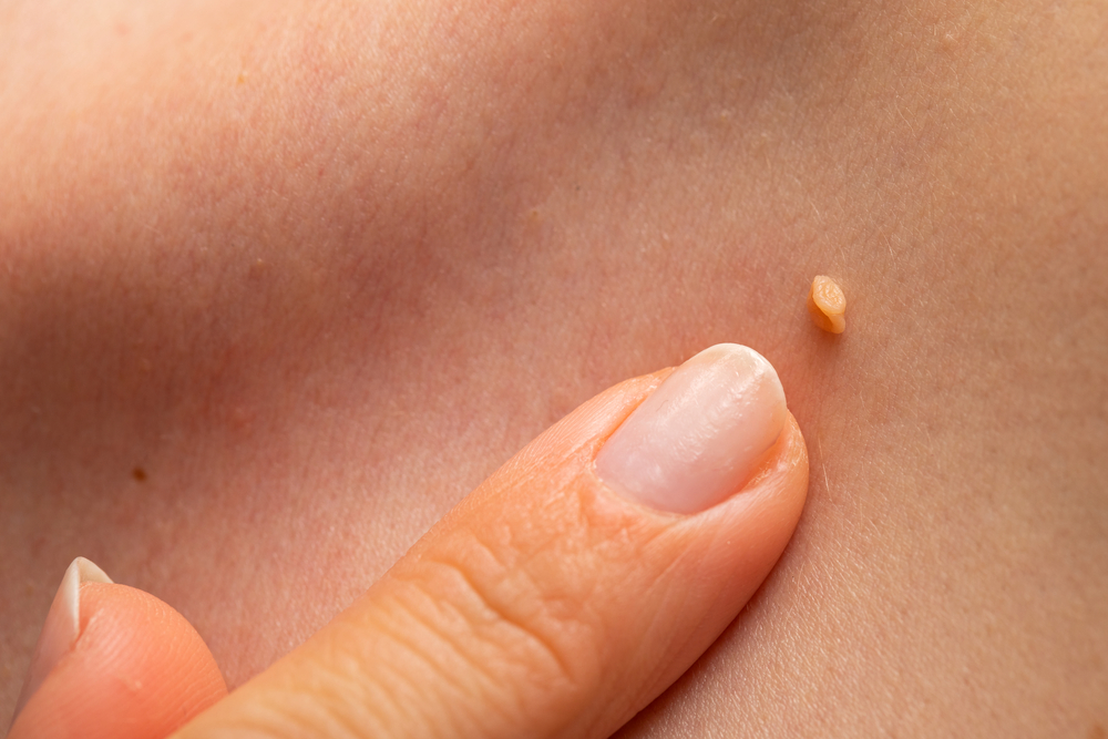 Cum să scapi de papiloame și negi odată pentru totdeauna? 10 remedii naturiste – Sănătate > Medicina alternativa Cum să scapi de papiloame și negi odată pentru totdeauna? 10 remedii naturiste – Sănătate > Medicina alternativa